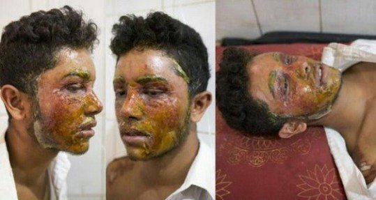 How 16 Year Old Girl Bathes Boy With Acid Because He Refused Her Love Proposal (Photos)