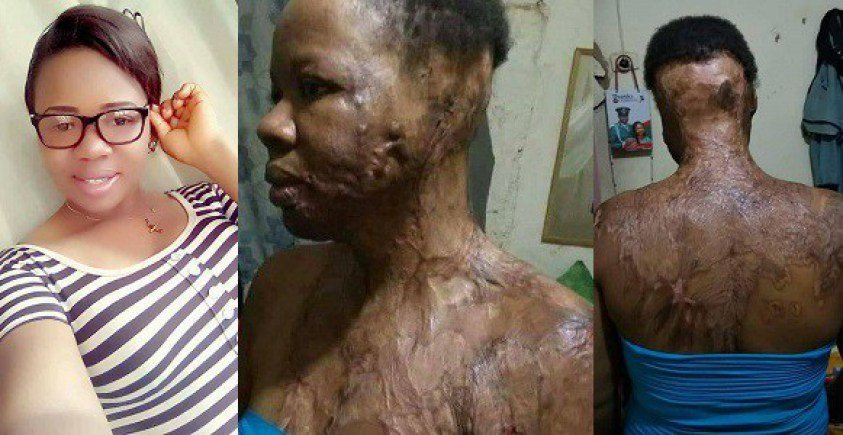 Wickedness!! UNIZIK Graduate Attacked With Acid By Unknown Man In Port-Harcourt (Photos)